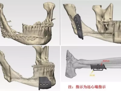 国内首例!齐鲁医院口腔科实施数字化3D打印钛板下颌骨重建手术DeepSeek小心,帝国反击战到来了